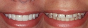 whitener teeth