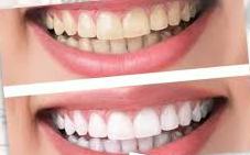 whitener teeth