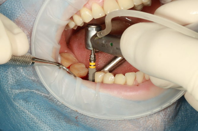 dental implants